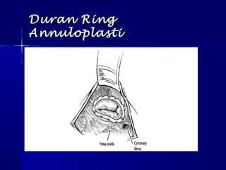 Duran RingDuran Ring
AnnuloplastiAnnuloplasti
 