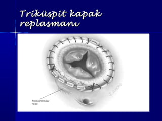 Triküspit kapakTriküspit kapak
replasmanıreplasmanı
 