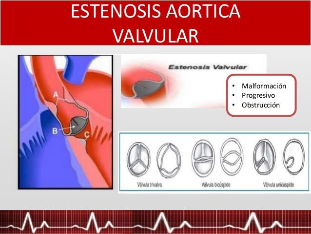 Estenosis Supravalvular Aortica Leve | CINEMAS 93