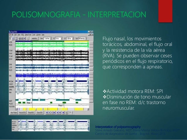 RONCOPATIA-INTERPRETACION DE POLISOMNOGRAFIA