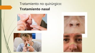 Tratamiento no quirúrgico:
Tratamiento nasal
 