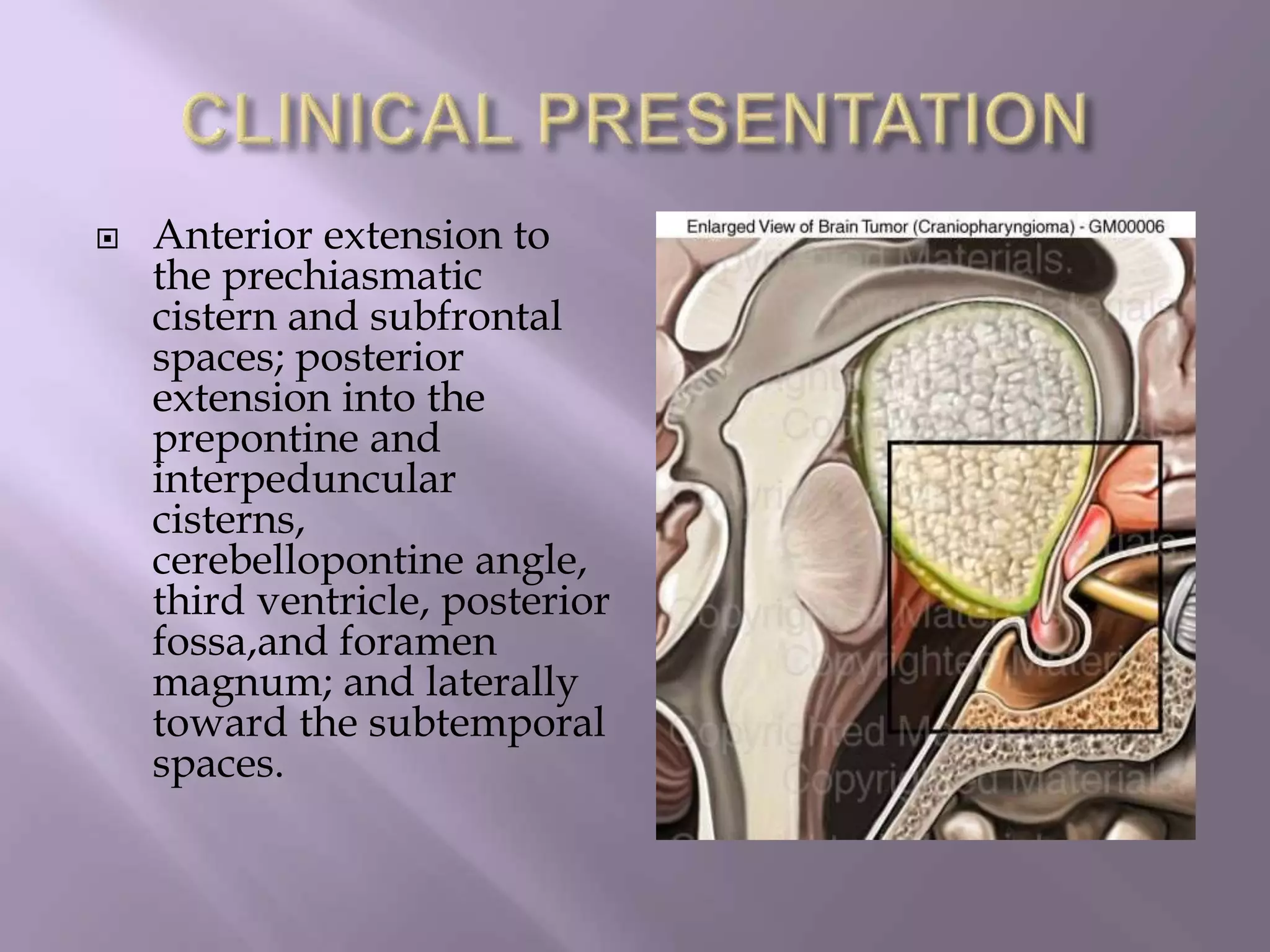  Anterior extension to
the prechiasmatic
cistern and subfrontal
spaces; posterior
extension into the
prepontine and
interpeduncular
cisterns,
cerebellopontine angle,
third ventricle, posterior
fossa,and foramen
magnum; and laterally
toward the subtemporal
spaces.
 