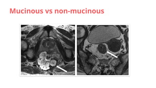 Mucinous Rcc Imaging in MRI of rectal carcinoma .pptx