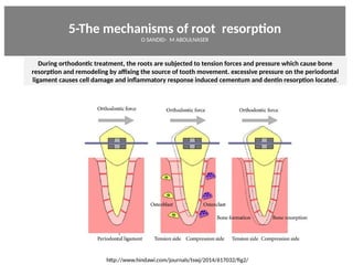 5-The mechanisms of root resorpton
O SANDID- M ABOULNASER
http://www.hindawi.com/journals/tswj/2014/617032/fig2/
During orthodontc treatment, the roots are subjected to tension forces and pressure which cause bone
resorpton and remodeling by affixing the source of tooth movement. excessive pressure on the periodontal
ligament causes cell damage and inflammatory response induced cementum and dentn resorpton located.
External Root resorpton in Orthodontcs-oussama sandid- olivier sandid -o sandid-mohamad aboualnaser-mohamad aboulnaser-m aboualnaser 
 