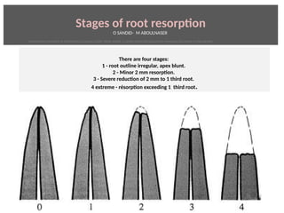 Stages of root resorpton
O SANDID- M ABOULNASER
There are four stages:
1 - root outline irregular, apex blunt.
2 - Minor 2 mm resorpton.
3 - Severe reducton of 2 mm to 1 third root.
4 extreme - résorpton exceeding 1 third root.
External Root resorpton in Orthodontcs-oussama sandid- olivier sandid -o sandid-mohamad aboualnaser-mohamad aboulnaser-m aboualnaser 
 