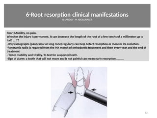 6-Root resorpton clinical manifestatons
O SANDID- M ABOULNASER
12
Poor: Mobility, no pain.
Whether the injury is permanent. It can decrease the length of the root of a few tenths of a millimeter up to
half. ... ??
-Only radiographs (panoramic or long cone) regularly can help detect resorpton or monitor its evoluton.
-Panoramic radio is required from the 9th month of orthodontc treatment and then every year and the end of
treatment
- Tester mobility and vitality. To test for suspected teeth.
-Sign of alarm: a tooth that will not move and is not painful can mean early resorpton..........
External Root resorpton in Orthodontcs-oussama sandid- olivier sandid -o sandid-mohamad aboualnaser-mohamad aboulnaser-m aboualnaser 
 