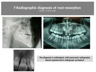 7-Radiographic diagnosis of root resorpton     
SANDID- M ABOULNASER
The diagnosis is radiological, with panoramic radiography,
lateral cephalometric radiograph, periapical.
External Root resorpton in Orthodontcs-oussama sandid- olivier sandid -o sandid-mohamad aboualnaser-mohamad aboulnaser-m aboualnaser 
 