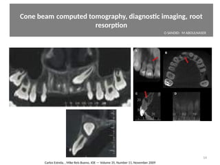 Cone beam computed tomography, diagnostc imaging, root   
resorpton
14
Carlos Estrela, , Mike Reis Bueno, JOE — Volume 35, Number 11, November 2009
O SANDID- M ABOULNASERExternal Root resorpton in Orthodontcs-oussama sandid- olivier sandid -o sandid-mohamad aboualnaser-mohamad aboulnaser-m aboualnaser 
 