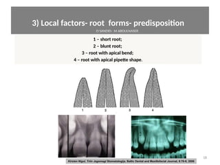 3) Local factors- root forms- predispositon 
1 – short root;
2 – blunt root;
3 – root with apical bend;
4 – root with apical pipette shape.
18
Kirsten Nigul, Triin Jagomagi Stomatologija, Baltic Dental and Maxillofacial Journal, 8:76-9, 2006
O SANDID- M ABOULNASER
oussama sandid-oussama-sandid-olivier sandid-olivier-sandid-mohamad aboualnaser-mohamad aboualnser-sandid-aboualnaser -mohmad aboulnaser
External Root resorpton in Orthodontcs-oussama sandid- olivier sandid -o sandid-mohamad aboualnaser-mohamad aboulnaser-m aboualnaser 
 