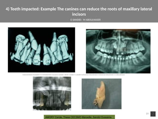 4) Teeth impacted: Example The canines can reduce the roots of maxillary lateral
incisors
19
AMORY Carole, These CECSMO Marseille, Sandid Oussama 
O SANDID- M ABOULNASER
oussama sandid-oussama-sandid-olivier sandid-olivier-sandid-mohamad aboualnaser-mohamad aboualnser-sandid-aboualnaser -mohmad aboulnaser
External Root resorpton in Orthodontcs-oussama sandid- olivier sandid -o sandid-mohamad aboualnaser-mohamad aboulnaser-m aboualnaser 
 