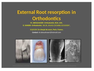 External Root resorpton in 
Orthodontcs
M. ABOULNASER- Orthodontist, BUA, USA.
O. SANDID- Orthodontist, D.C.D., D.U.O, C.E.S.B.B, C.E.S.O.D.F ,
S.Q.O.D.F, Ex chargé de cours, Paris. France.
Contact: dr.aboualnaser@hotmail.com
oussama sandid-oussama-sandid-olivier sandid-olivier-sandid-mohamad aboualnaser-mohamad aboualnser-sandid-aboualnaser -mohmad aboulnaser
 