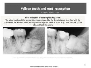 Wilson teeth and root resorpton
20
Minoru Yamaoka, Australian Dental Journal 1999;44:2.
Root resorpton of the neighbouring tooth
The inflammaton of the surrounding tssues caused by the dental plaque, together with the
pressure of the wisdom tooth pushing on the adjacent tooth in front, may cause the root of the
adjacent tooth to resorb
O SANDID- M ABOULNASER
oussama sandid-oussama-sandid-olivier sandid-olivier-sandid-mohamad aboualnaser-mohamad aboualnser-sandid-aboualnaser -mohmad aboulnaser
External Root resorpton in Orthodontcs-oussama sandid- olivier sandid -o sandid-mohamad aboualnaser-mohamad aboulnaser-m aboualnaser 
 