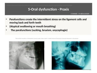 5-Oral dysfuncton - Praxis
• Parafunctons create the intermittent stress on the ligament cells and
moving back and forth teeth
• (Atypical swallowing or mouth breathing)
•   The parafunctons (sucking, bruxism, onycophagie)
21
O SANDID- M ABOULNASER
oussama sandid-oussama-sandid-olivier sandid-olivier-sandid-mohamad aboualnaser-mohamad aboualnser-sandid-aboualnaser -mohmad aboulnaser
External Root resorpton in Orthodontcs-oussama sandid- olivier sandid -o sandid-mohamad aboualnaser-mohamad aboulnaser-m aboualnaser 
 