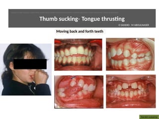 Sandid oussama
Thumb sucking- Tongue thrustng
Moving back and forth teeth
O SANDID- M ABOULNASER
oussama sandid-oussama-sandid-olivier sandid-olivier-sandid-mohamad aboualnaser-mohamad aboualnser-sandid-aboualnaser -mohmad aboulnaser
External Root resorpton in Orthodontcs-oussama sandid- olivier sandid -o sandid-mohamad aboualnaser-mohamad aboulnaser-m aboualnaser 
 