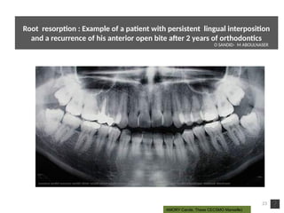 23
AMORY Carole, These CECSMO Marseille)
Root resorpton : Example of a patent with persistent lingual interpositon
and a recurrence of his anterior open bite after 2 years of orthodontcs
O SANDID- M ABOULNASER
oussama sandid-oussama-sandid-olivier sandid-olivier-sandid-mohamad aboualnaser-mohamad aboualnser-sandid-aboualnaser -mohmad aboulnaser
External Root resorpton in Orthodontcs-oussama sandid- olivier sandid -o sandid-mohamad aboualnaser-mohamad aboulnaser-m aboualnaser 
 