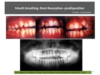 Mouth breathing -Root Resorpton- predispositon
24
Ahu Topkara, Ali I Karaman, Chung H Kau, European Journal of Dentistry, October 2012 - Vol.6 
O SANDID- M ABOULNASER
oussama sandid-oussama-sandid-olivier sandid-olivier-sandid-mohamad aboualnaser-mohamad aboualnser-sandid-aboualnaser -mohmad aboulnaser
External Root resorpton in Orthodontcs-oussama sandid- olivier sandid -o sandid-mohamad aboualnaser-mohamad aboulnaser-m aboualnaser 
 