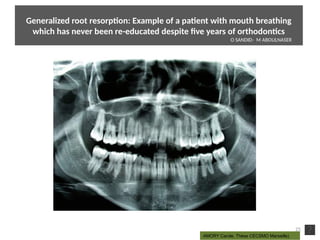 25
AMORY Carole, Thèse CECSMO Marseille)
Generalized root resorpton: Example of a patent with mouth breathing
which has never been re-educated despite five years of orthodontcs
O SANDID- M ABOULNASER
oussama sandid-oussama-sandid-olivier sandid-olivier-sandid-mohamad aboualnaser-mohamad aboualnser-sandid-aboualnaser -mohmad aboulnaser
External Root resorpton in Orthodontcs-oussama sandid- olivier sandid -o sandid-mohamad aboualnaser-mohamad aboulnaser-m aboualnaser 
 