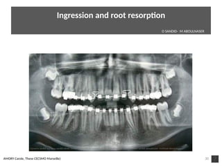 30AMORY Carole, These CECSMO Marseille)
Ingression and root resorpton
O SANDID- M ABOULNASER
oussama sandid-oussama-sandid-olivier sandid-olivier-sandid-mohamad aboualnaser-mohamad aboualnser-sandid-aboualnaser -mohmad aboulnaser
External Root resorpton in Orthodontcs-oussama sandid- olivier sandid -o sandid-mohamad aboualnaser-mohamad aboulnaser-m aboualnaser 
 