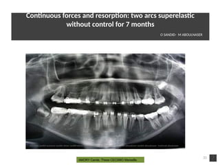 31
AMORY Carole, These CECSMO Marseille.
Contnuous forces and resorpton: two arcs superelastc
without control for 7 months
O SANDID- M ABOULNASER
oussama sandid-oussama-sandid-olivier sandid-olivier-sandid-mohamad aboualnaser-mohamad aboualnser-sandid-aboualnaser -mohmad aboulnaser
External Root resorpton in Orthodontcs-oussama sandid- olivier sandid -o sandid-mohamad aboualnaser-mohamad aboulnaser-m aboualnaser 
 