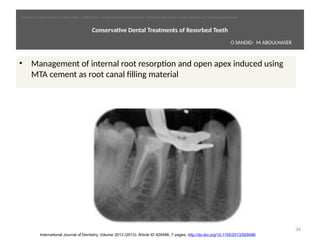  
Conservatve Dental Treatments of Resorbed Teeth
• Management of internal root resorpton and open apex induced using
MTA cement as root canal filling material
34
International Journal of Dentistry, Volume 2013 (2013), Article ID 929486, 7 pages, http://dx.doi.org/10.1155/2013/929486
O SANDID- M ABOULNASER
oussama sandid-oussama-sandid-olivier sandid-olivier-sandid-mohamad aboualnaser-mohamad aboualnser-sandid-aboualnaser -mohmad aboulnaser
External Root resorpton in Orthodontcs-oussama sandid- olivier sandid -o sandid-mohamad aboualnaser-mohamad aboulnaser-m aboualnaser 
 