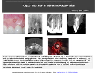 Surgical Treatment of Internal Root Resorpton
Surgical management of an internal resorpton through a retrofilling with MTA (tooth 11). (a) Preoperatve view: presence of a sinus
tract. (b) Preoperatve intraoral radiography with a gutta percha point in the sinus tract, leading to the source of infecton .(c), (d),
and (e) Sagittal, coronal, and axial CBCT cross-sectons. (f) Surgical cleaning of the root resorptve lesion and retrofilling with MTA.
(g) Postoperatve periapical X-ray of the root treatment: the filling is dense without overfilling. (h) One year followup: the clinical
view confirms the sinus tract disappearance and the healthy appearance of the gums. (i) Periapical X-ray corroborates the
periodontal regeneraton in close contact with MTA filling.
International Journal of Dentistry, Volume 2013 (2013), Article ID 929486, 7 pages, http://dx.doi.org/10.1155/2013/929486
O SANDID- M ABOULNASER
oussama sandid-oussama-sandid-olivier sandid-olivier-sandid-mohamad aboualnaser-mohamad aboualnser-sandid-aboualnaser -mohmad aboulnaser
External Root resorpton in Orthodontcs-oussama sandid- olivier sandid -o sandid-mohamad aboualnaser-mohamad aboulnaser-m aboualnaser 
 