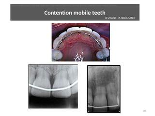 Contenton mobile teeth
38
O SANDID- M ABOULNASER
oussama sandid-oussama-sandid-olivier sandid-olivier-sandid-mohamad aboualnaser-mohamad aboualnser-sandid-aboualnaser -mohmad aboulnaser
External Root resorpton in Orthodontcs-oussama sandid- olivier sandid -o sandid-mohamad aboualnaser-mohamad aboulnaser-m aboualnaser 
 