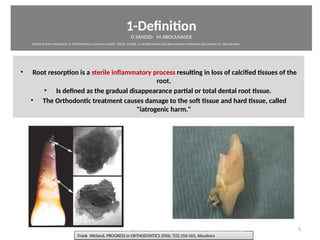 1-Definiton
O SANDID- M ABOULNASER
• Root resorpton is a sterile inflammatory process resultng in loss of calcified tssues of the
root.
• Is defined as the gradual disappearance partal or total dental root tssue.
• The Orthodontc treatment causes damage to the soft tssue and hard tssue, called
"iatrogenic harm."
5
Frank Weiland, PROGRESS in ORTHODONTICS 2006; 7(2):156-163, AbuabaraFrank Weiland, PROGRESS in ORTHODONTICS 2006; 7(2):156-163, Abuabara
oussama sandid-oussama-sandid-olivier sandid-olivier-sandid-mohamad aboualnaser-mohamad aboualnser-sandid-aboualnaser -mohmad aboulnaser
External Root resorpton in Orthodontcs-oussama sandid- olivier sandid -o sandid-mohamad aboualnaser-mohamad aboulnaser-m aboualnaser 
External Root resorpton in Orthodontcs-oussama sandid- olivier sandid -o sandid-mohamad aboualnaser-mohamad aboulnaser-m aboualnaser 
 