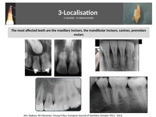 3-Localisaton
O SANDID- M ABOULNASER
The most affected teeth are the maxillary incisors, the mandibular incisors, canines, premolars
molars
7
Ahu Topkara, Ali I Karaman, Chung H Kau, European Journal of Dentstry, October 2012 - Vol.6
External Root resorpton in Orthodontcs-oussama sandid- olivier sandid -o sandid-mohamad aboualnaser-mohamad aboulnaser-m aboualnaser 
 