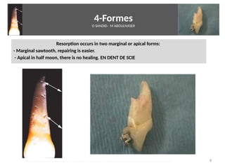 4-Formes
O SANDID- M ABOULNASER
Resorpton occurs in two marginal or apical forms:
- Marginal sawtooth, repairing is easier.
- Apical in half moon, there is no healing. EN DENT DE SCIE
8External Root resorpton in Orthodontcs-oussama sandid- olivier sandid -o sandid-mohamad aboualnaser-mohamad aboulnaser-m aboualnaser 
 