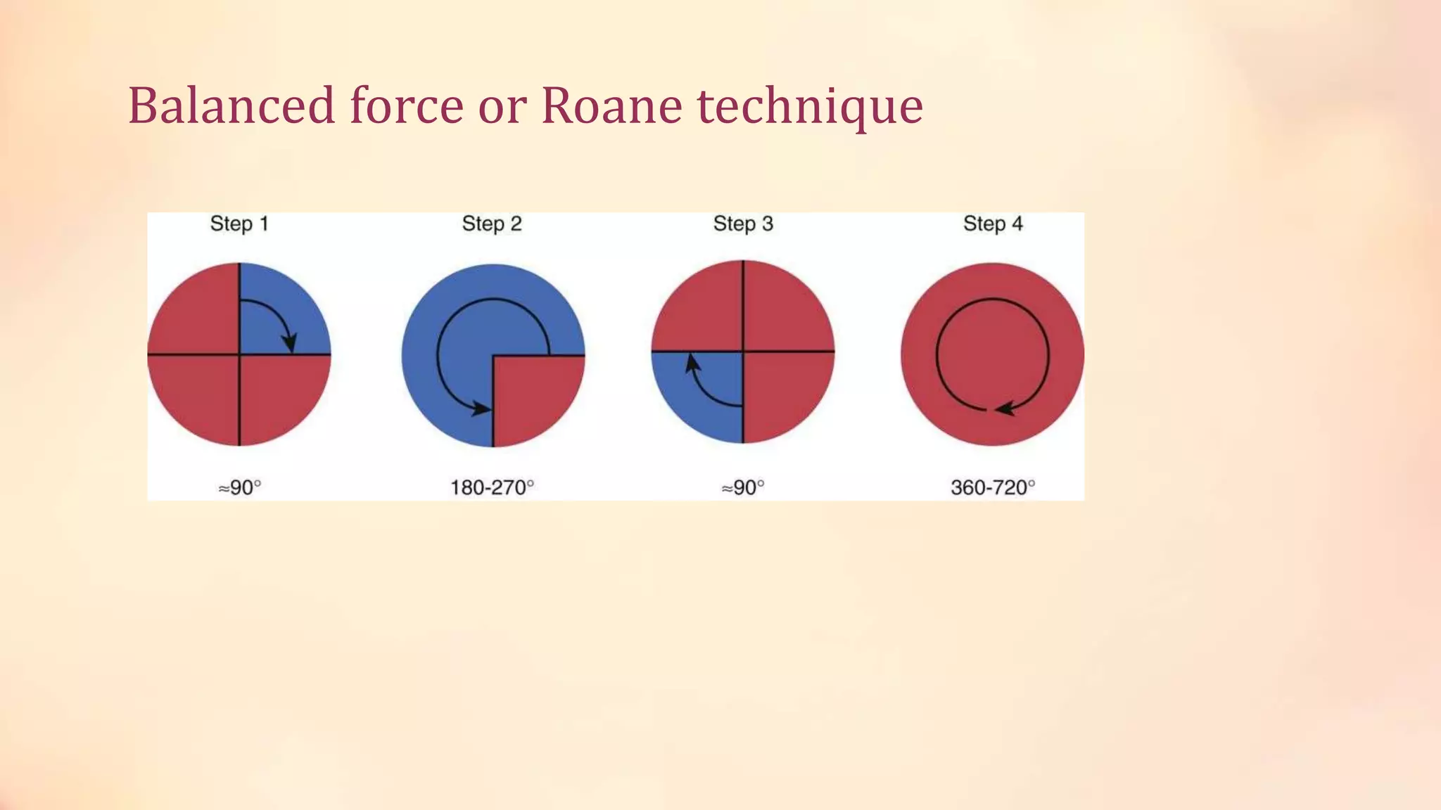 Balanced force or Roane technique 
 