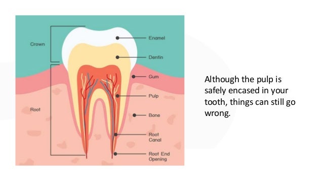 Root Canal What It Is And Why You May Need One
