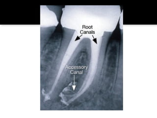 Root canal anatomy and access cavities | PPT