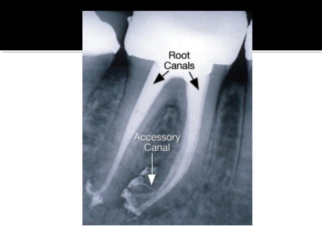 Root canal anatomy and access cavities