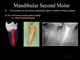 Root Fusion Root canal anatomy and configuration project mandibular teeth ...