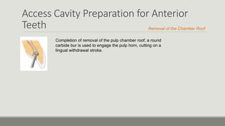Access Cavity Preparation for Anterior
Teeth
Completion of removal of the pulp chamber roof; a round
carbide bur is used to engage the pulp horn, cutting on a
lingual withdrawal stroke.
Removal of the Chamber Roof
 