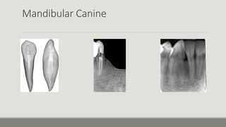 Mandibular Canine
 