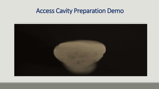 Access Cavity Preparation Demo
 