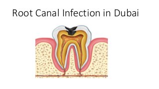 Root Canal Infection in Dubai
 