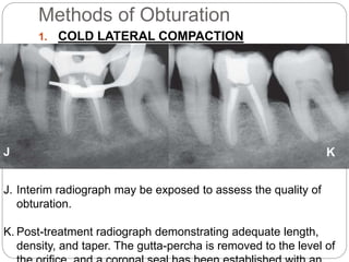 Root canal obturation timing materials and techniques | PPTX