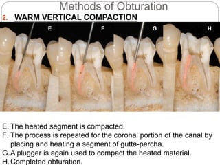 Root canal obturation timing materials and techniques | PPTX