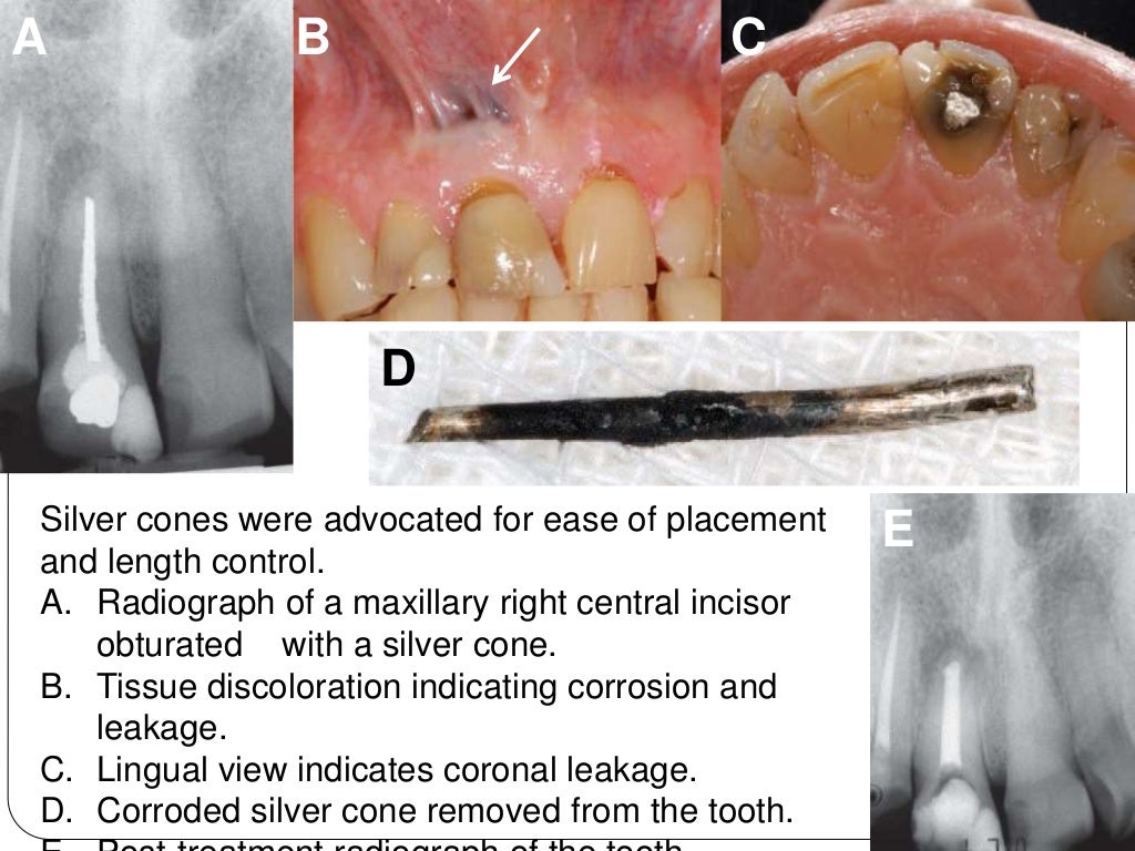 Root canal obturation timing materials and techniques
