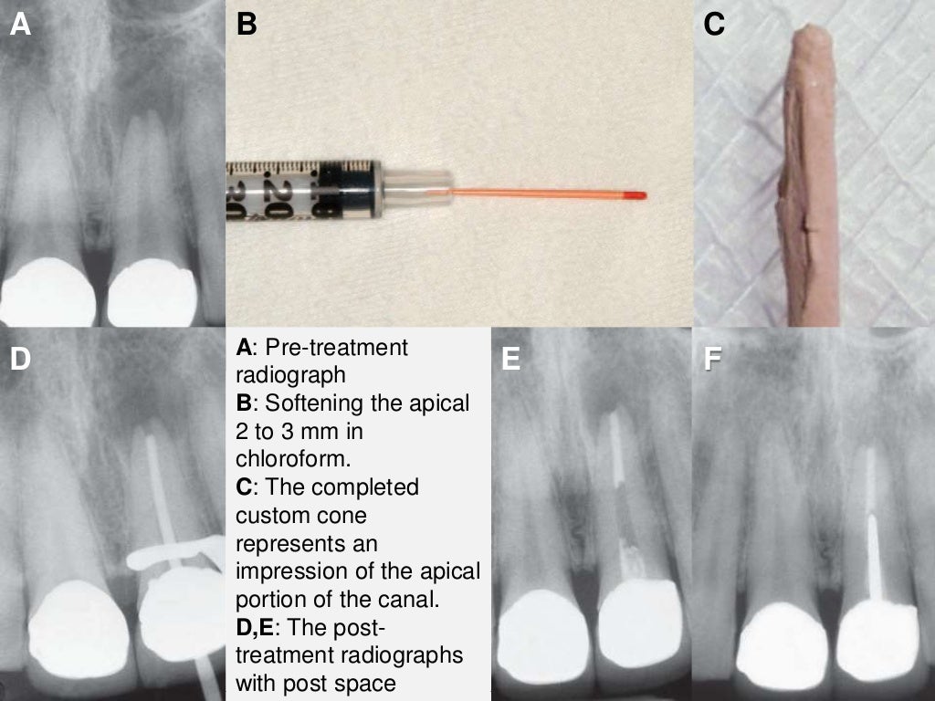 Root canal obturation timing materials and techniques