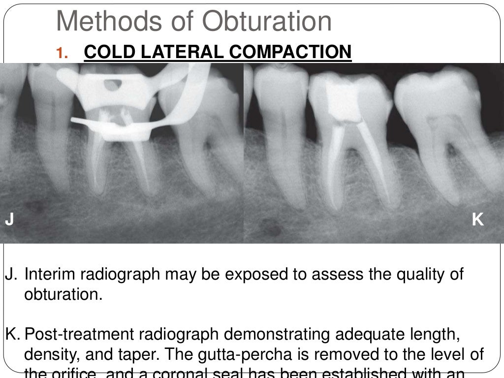 Root canal obturation timing materials and techniques