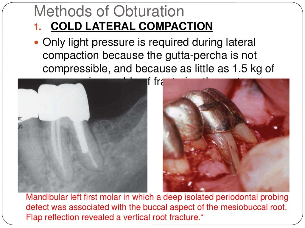 Root canal obturation timing materials and techniques