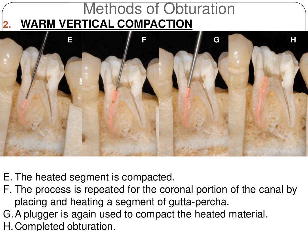 Root canal obturation timing materials and techniques