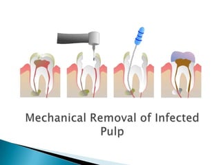 Mechanical Removal of Infected Pulp