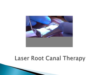 Laser Root Canal Therapy