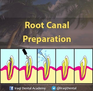 Root Canal Preparation Simplified