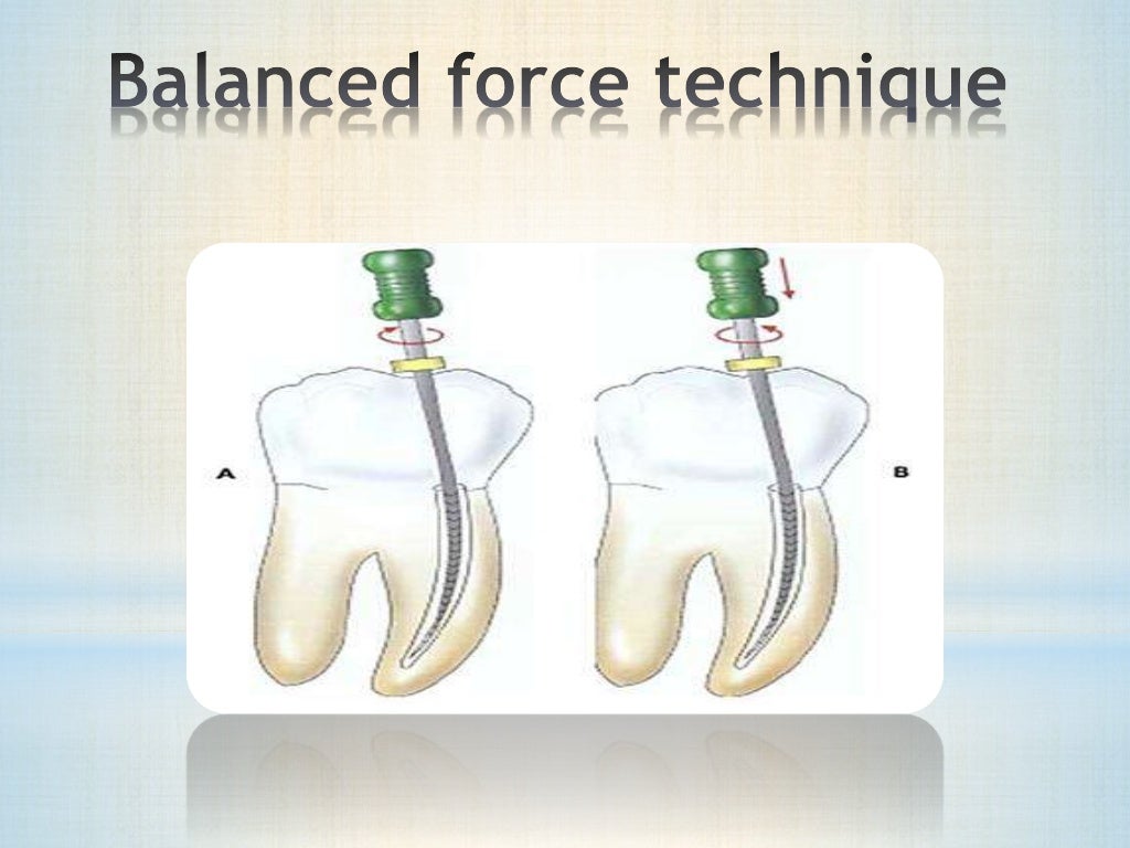 Root canal preparation techniques _ endodontic treatment