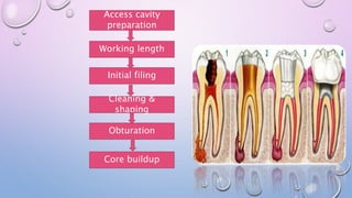 Access cavity
preparation
Working length
Initial filing
Cleaning &
shaping
Obturation
Core buildup
 